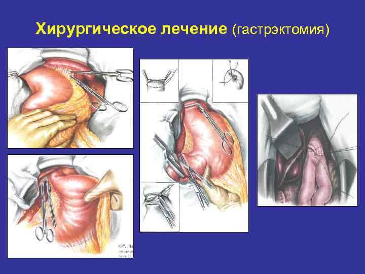 Хирургическое лечение (гастрэктомия) 