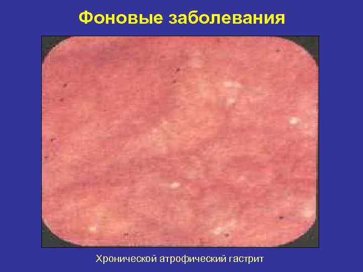 Фоновые заболевания Хронической атрофический гастрит 
