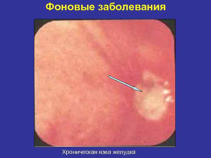 Фоновые заболевания Хроническая язва желудка 