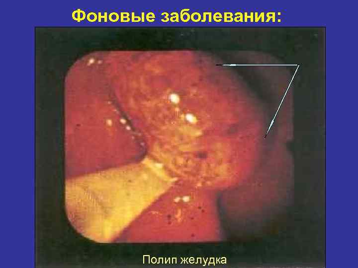 Фоновые заболевания: Полип желудка 