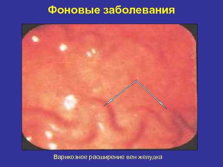 Фоновые заболевания Варикозное расширение вен желудка 