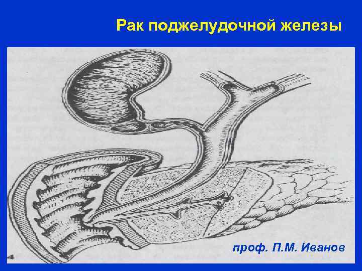 Рак поджелудочной железы проф. П. М. Иванов 