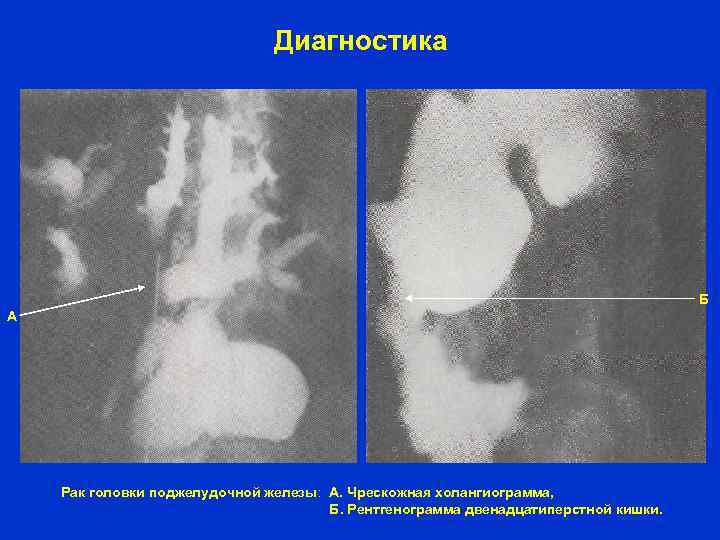 Диагностика Б А Рак головки поджелудочной железы: А. Чрескожная холангиограмма, Б. Рентгенограмма двенадцатиперстной кишки.