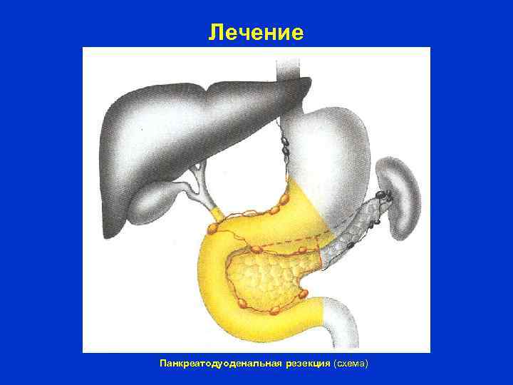 Лечение Панкреатодуоденальная резекция (схема) 