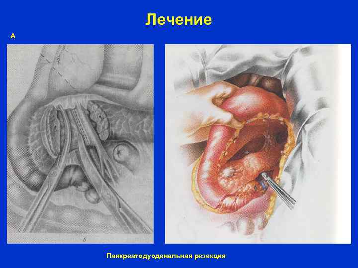 Лечение А Панкреатодуоденальная резекция 