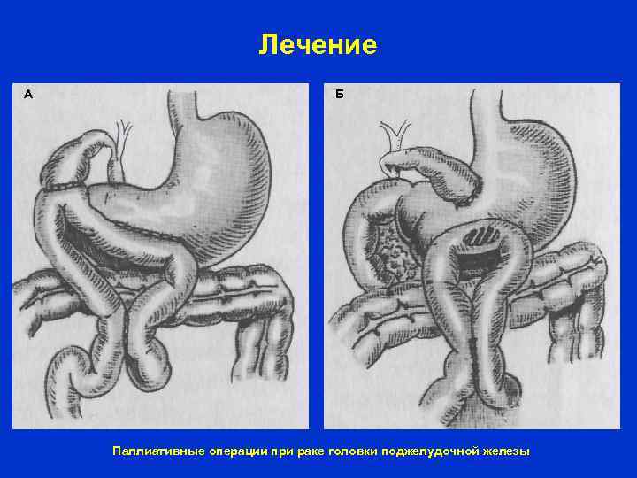 Лечение А Б Паллиативные операции при раке головки поджелудочной железы 