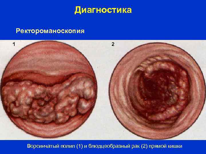 Диагностика Ректороманоскопия 1 2 Ворсинчатый полип (1) и блюдцеобразный рак (2) прямой кишки 