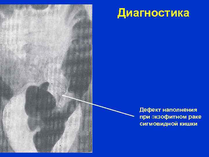 Диагностика Дефект наполнения при экзофитном раке сигмовидной кишки 
