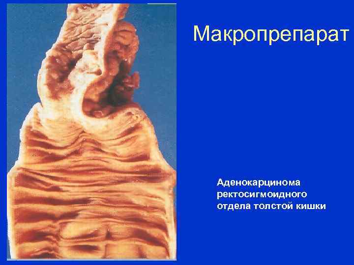Макропрепарат Аденокарцинома ректосигмоидного отдела толстой кишки 