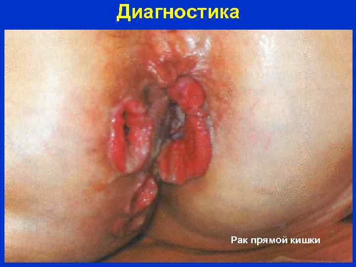 Диагностика Рак прямой кишки 