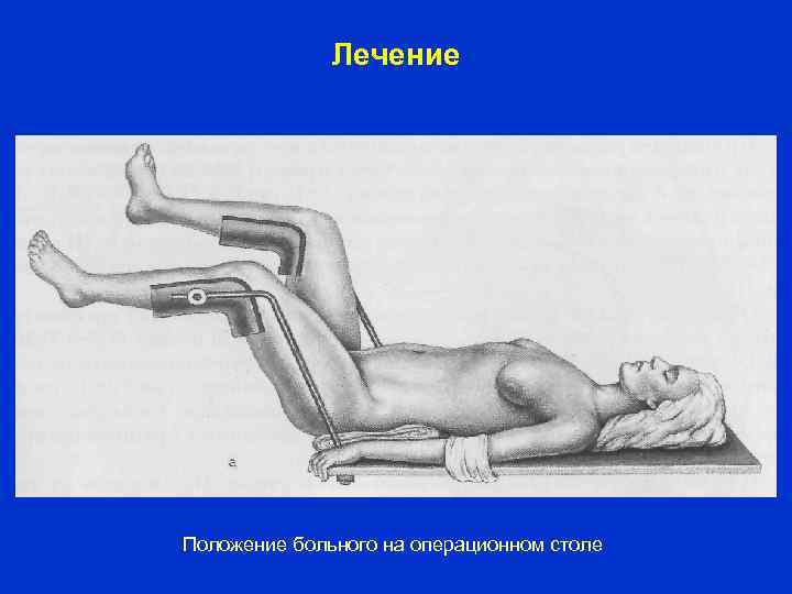 Лечение Положение больного на операционном столе 