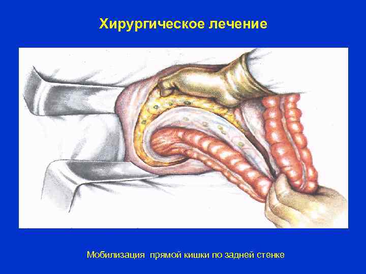 Хирургическое лечение Мобилизация прямой кишки по задней стенке 