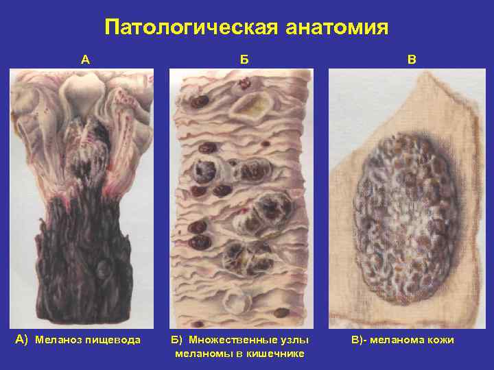 Патологическая анатомия А А) Меланоз пищевода Б Б) Множественные узлы меланомы в кишечнике В