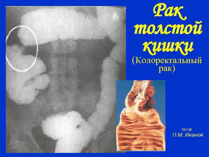 Рак толстой кишки (Колоректальный рак) проф. П. М. Иванов 