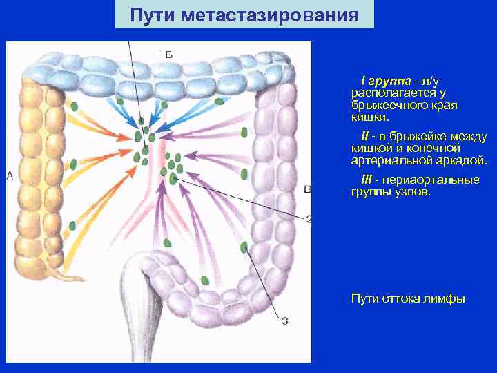 Пути метастазирования I группа –л/у располагается у брыжеечного края кишки. II - в брыжейке
