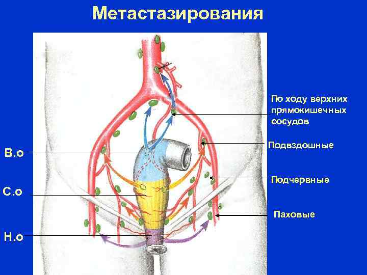Метастазирования По ходу верхних прямокишечных сосудов В. о С. о Подвздошные Подчервные Паховые Н.
