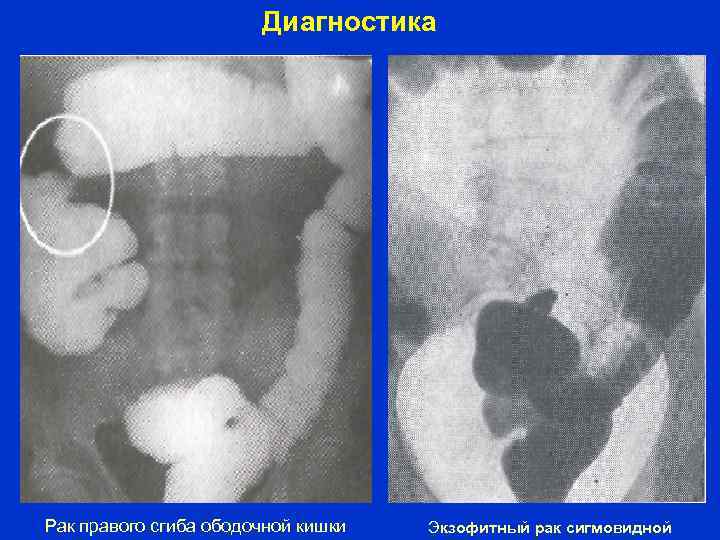 Диагностика Рак правого сгиба ободочной кишки Экзофитный рак сигмовидной 