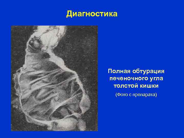 Диагностика Полная обтурация печеночного угла толстой кишки (Фото с препарата) 