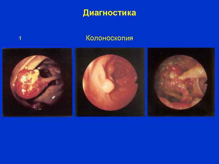 Диагностика 1 Колоноскопия 