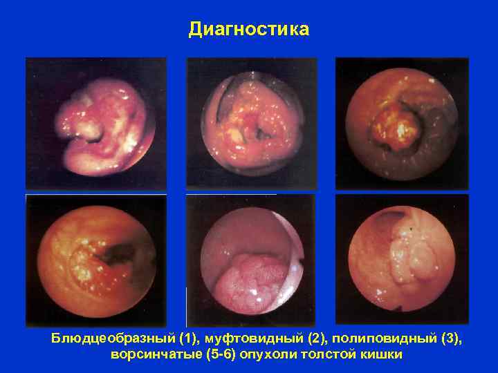 Диагностика Блюдцеобразный (1), муфтовидный (2), полиповидный (3), ворсинчатые (5 -6) опухоли толстой кишки 