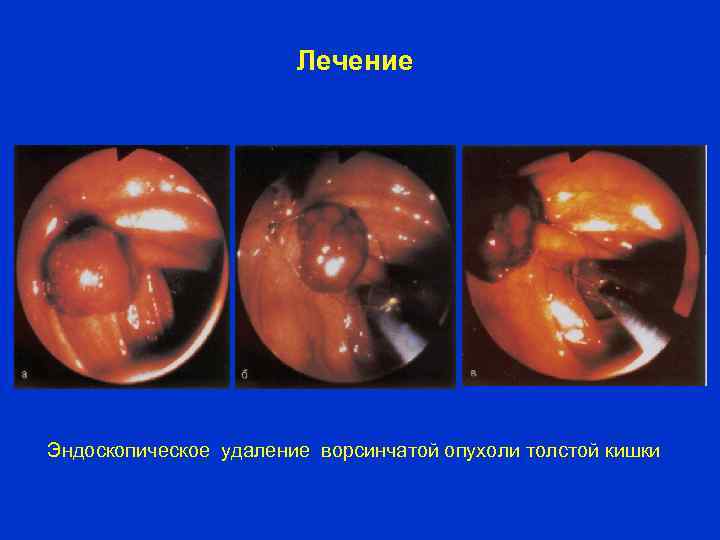 Лечение Эндоскопическое удаление ворсинчатой опухоли толстой кишки 