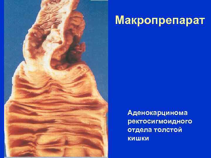Макропрепарат Аденокарцинома ректосигмоидного отдела толстой кишки 
