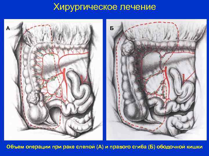 Хирургическое лечение А Б Объем операции при раке слепой (А) и правого сгиба (Б)