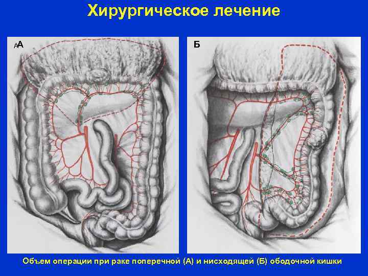 Хирургическое лечение А А Б Объем операции при раке поперечной (А) и нисходящей (Б)