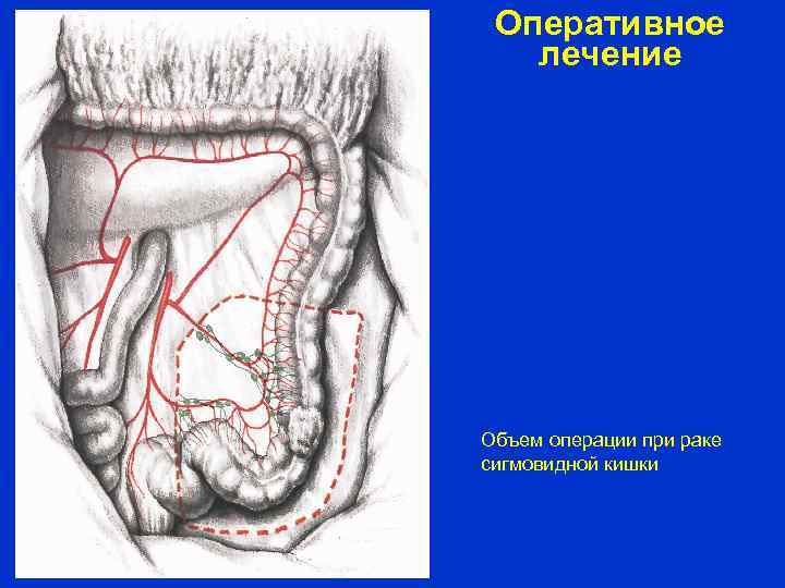 Оперативное лечение Объем операции при раке сигмовидной кишки 