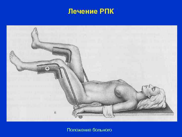 Лечение РПК Положение больного 