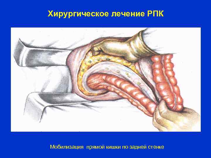 Хирургическое лечение РПК Мобилизация прямой кишки по задней стенке 