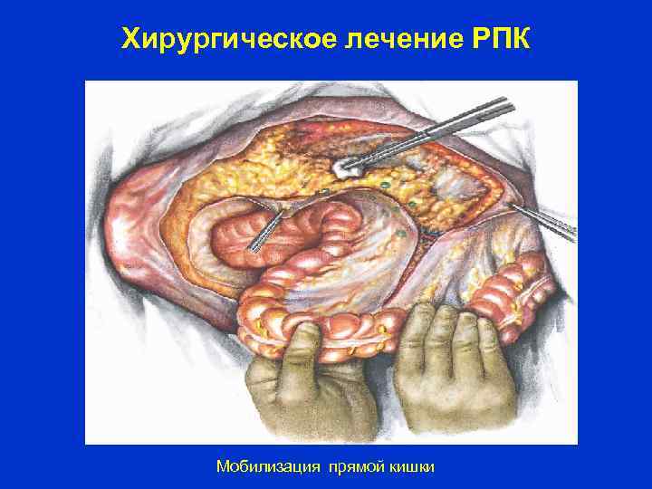 Хирургическое лечение РПК Мобилизация прямой кишки 