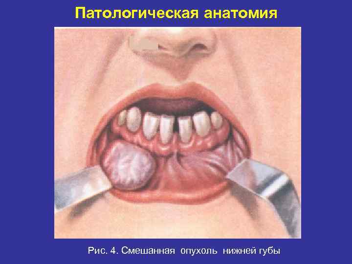 Патологическая анатомия . Рис. 4. Смешанная опухоль нижней губы 