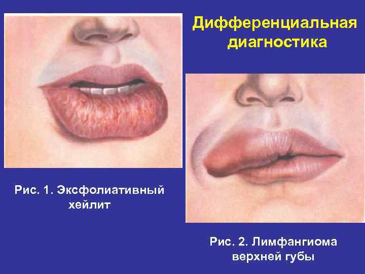 Дифференциальная диагностика Рис. 1. Эксфолиативный хейлит Рис. 2. Лимфангиома верхней губы 