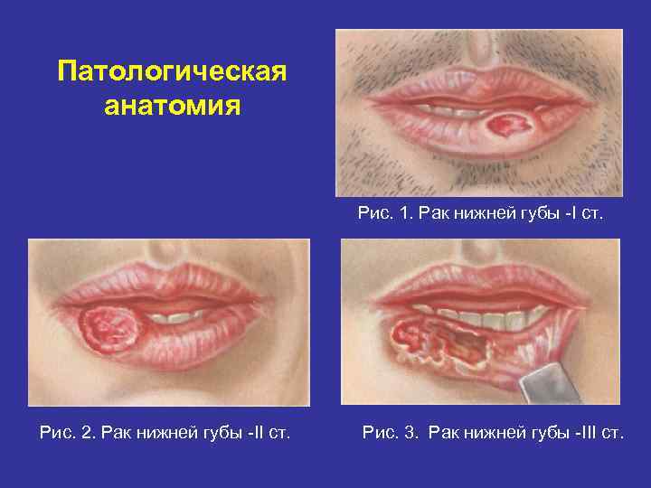 Патологическая анатомия Рис. 1. Рак нижней губы I ст. Рис. 2. Рак нижней губы