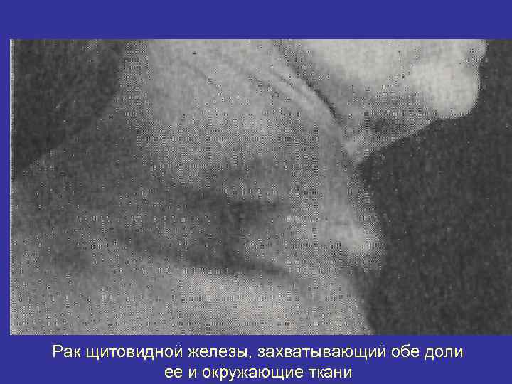 Рак щитовидной железы, захватывающий обе доли ее и окружающие ткани 