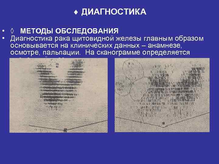  ДИАГНОСТИКА • ◊ МЕТОДЫ ОБСЛЕДОВАНИЯ • Диагностика рака щитовидной железы главным образом основывается