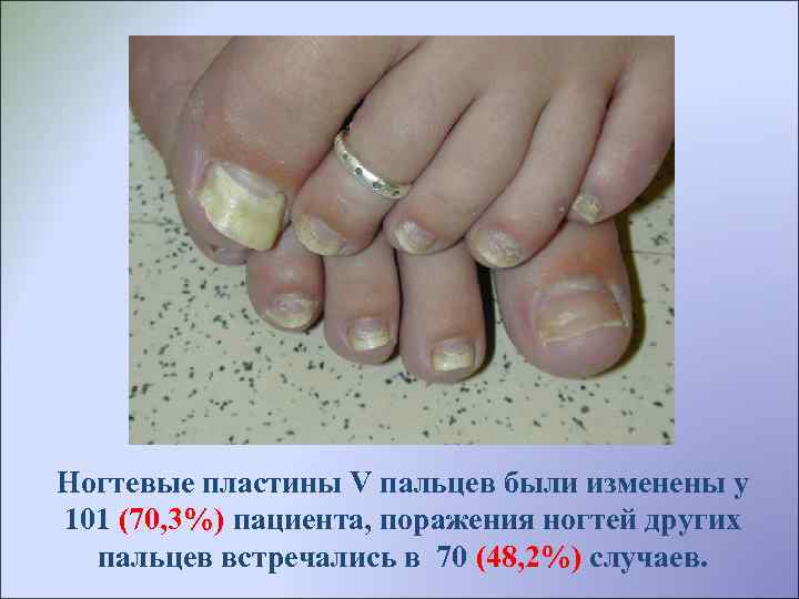 Ногтевые пластины V пальцев были изменены у 101 (70, 3%) пациента, поражения ногтей других