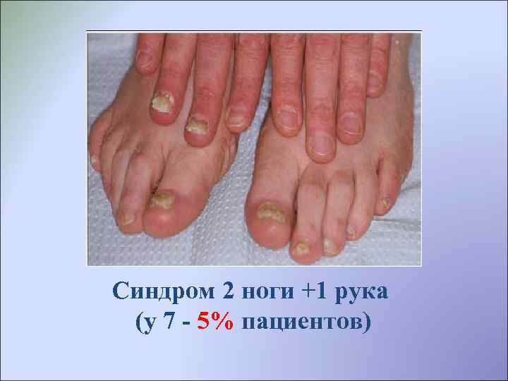 Синдром 2 ноги +1 рука (у 7 - 5% пациентов) 