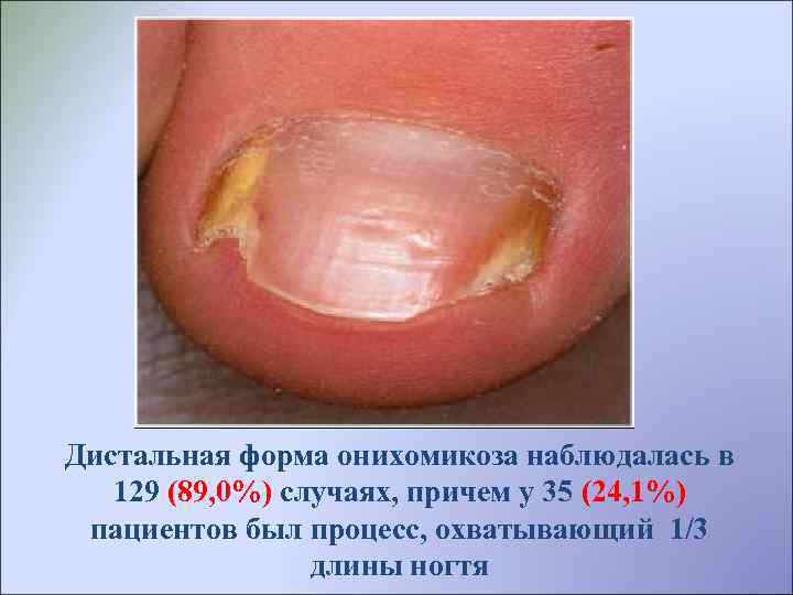 Дистальная форма онихомикоза наблюдалась в 129 (89, 0%) случаях, причем у 35 (24, 1%)