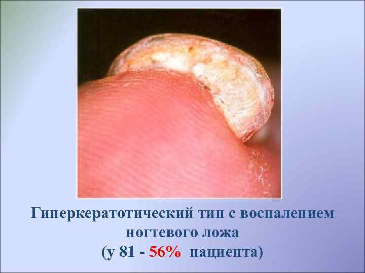 Гиперкератотический тип с воспалением ногтевого ложа (у 81 - 56% пациента) 