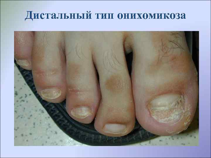 Дистальный тип онихомикоза 