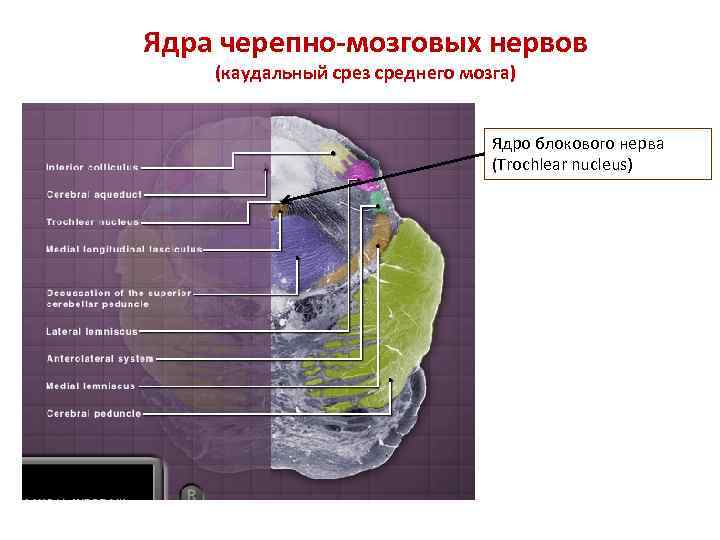 Ядра черепно-мозговых нервов (каудальный срез среднего мозга) Ядро блокового нерва (Trochlear nucleus) 