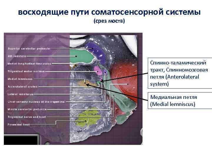 восходящие пути соматосенсорной системы (срез моста) Спинно-таламический тракт, Спинномозговая петля (Anterolateral system) Медиальная петля