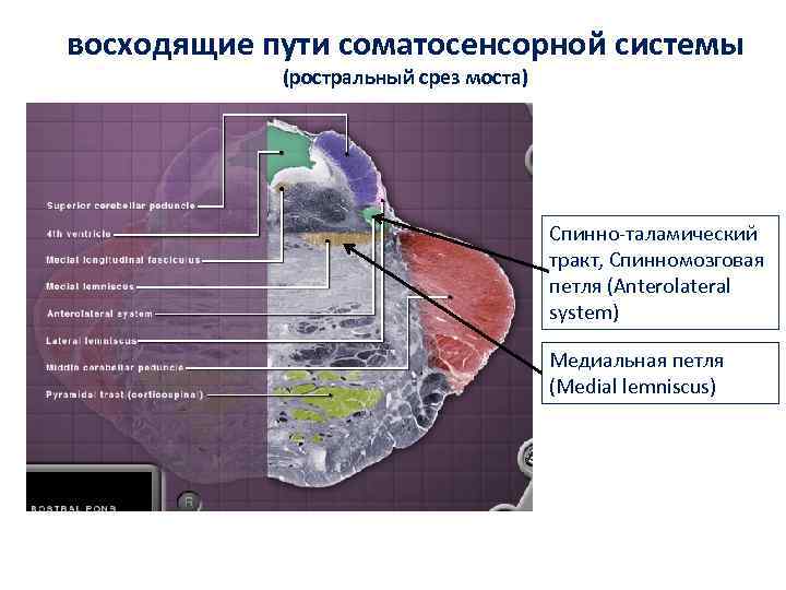 восходящие пути соматосенсорной системы (ростральный срез моста) Спинно-таламический тракт, Спинномозговая петля (Anterolateral system) Медиальная