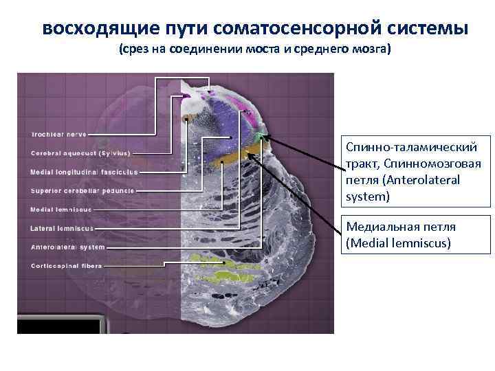 восходящие пути соматосенсорной системы (срез на соединении моста и среднего мозга) Спинно-таламический тракт, Спинномозговая