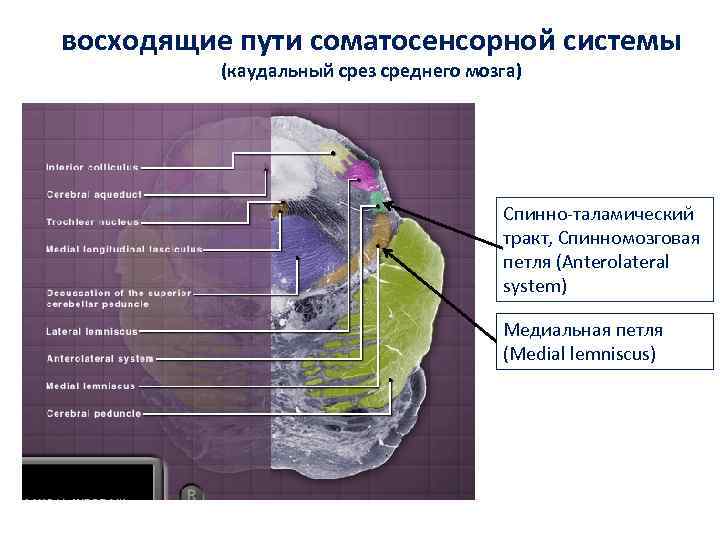 восходящие пути соматосенсорной системы (каудальный срез среднего мозга) Спинно-таламический тракт, Спинномозговая петля (Anterolateral system)