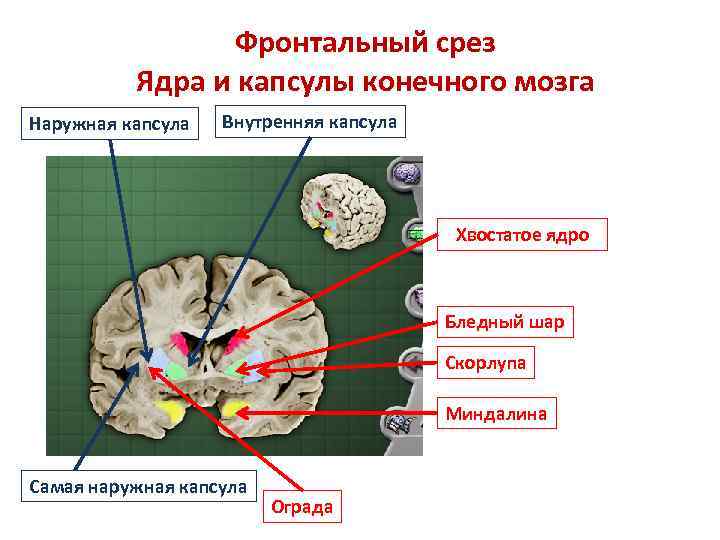 Что такое срез. Внутренняя капсула головного мозга анатомия. Базальные ядра головного мозга. Внутренняя капсула. Схема базальных ядер и внутренней капсулы. Фронтальный срез головного мозга базальные ядра.