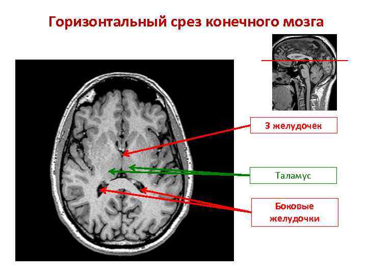 Горизонтальный срез конечного мозга 3 желудочек Таламус Боковые желудочки 