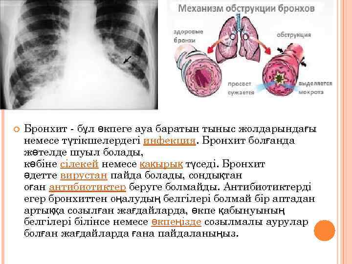  Бронхит - бұл өкпеге ауа баратын тыныс жолдарындағы немесе түтікшелердегі инфекция. Бронхит болғанда